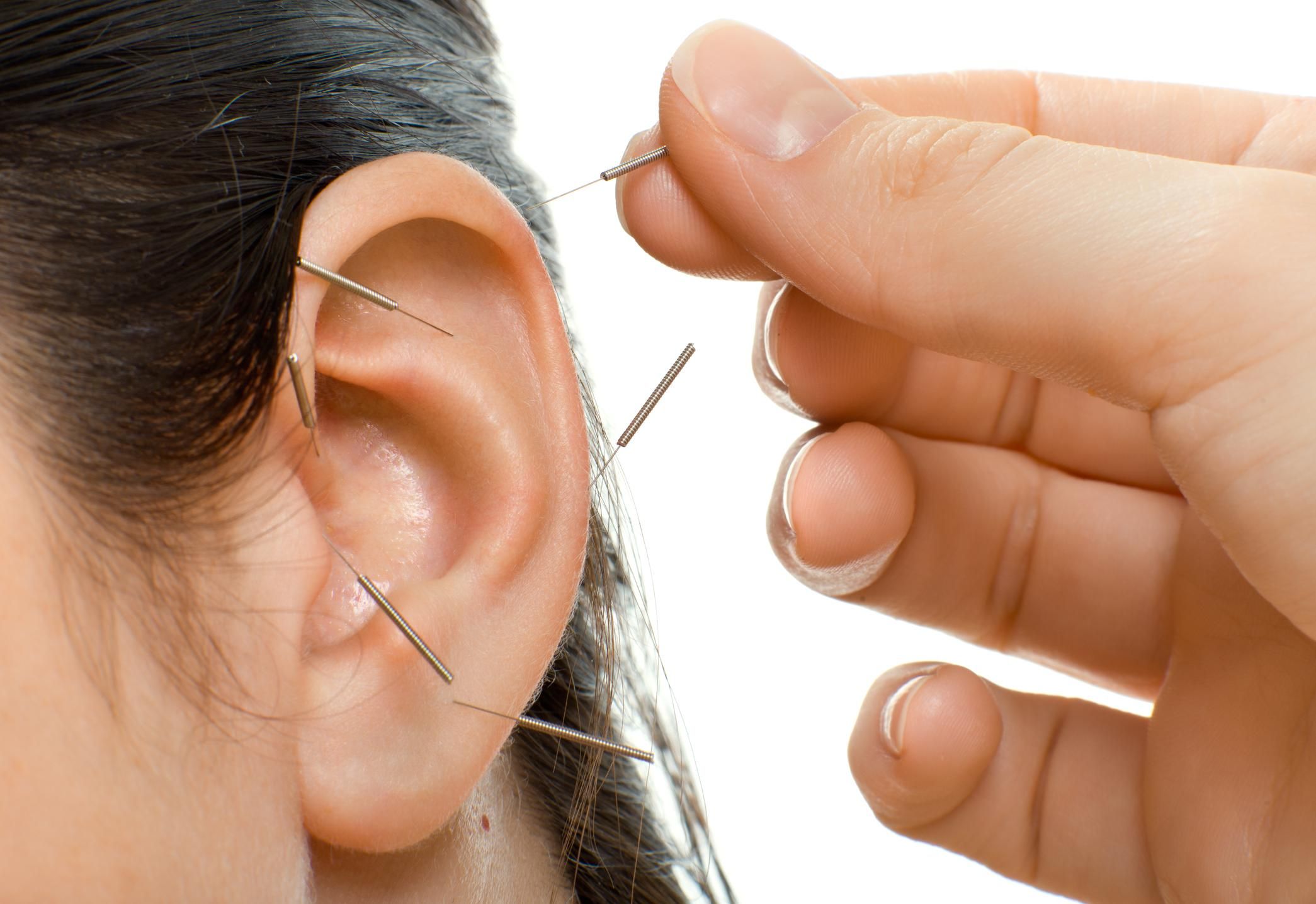 Acupuncture needles in the ear