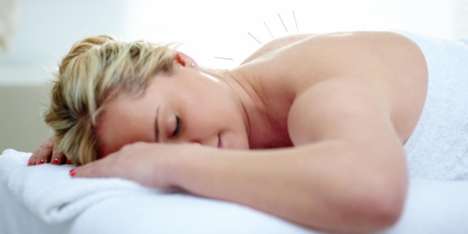 Acupuncture needles on the back of a young woman