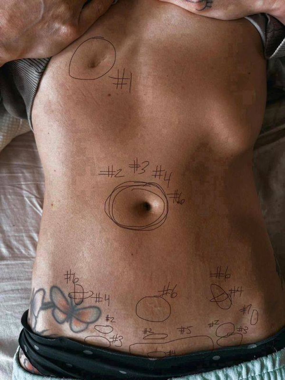 allison's surgery scars