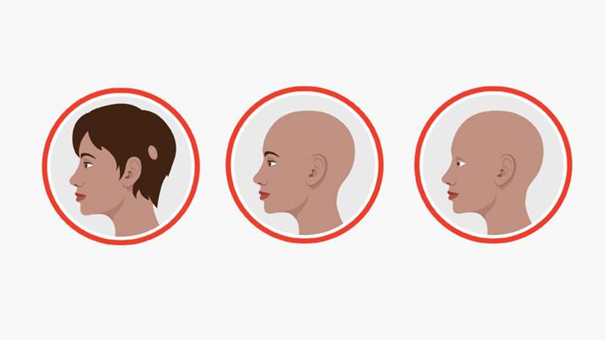 Alopecia Areata: Losing Your Hair? Don’t Despair