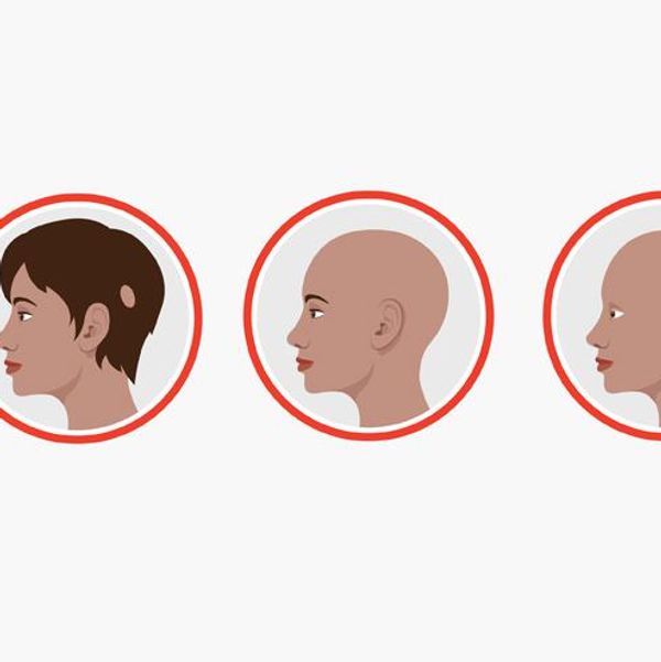 Alopecia Areata: Losing Your Hair? Don’t Despair