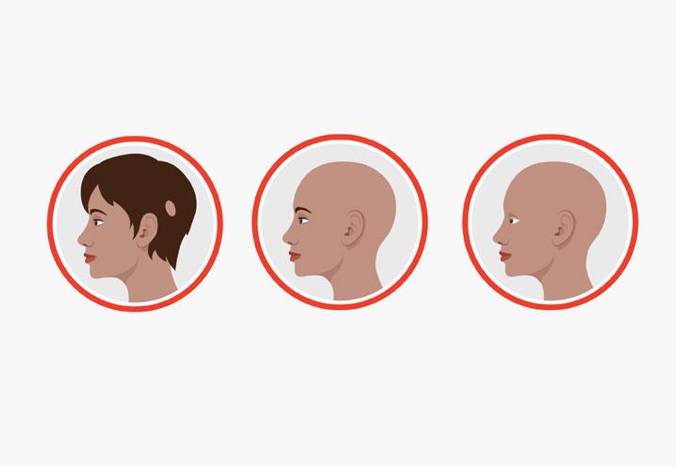 Alopecia Areata: Losing Your Hair? Don't Despair - HealthyWomen