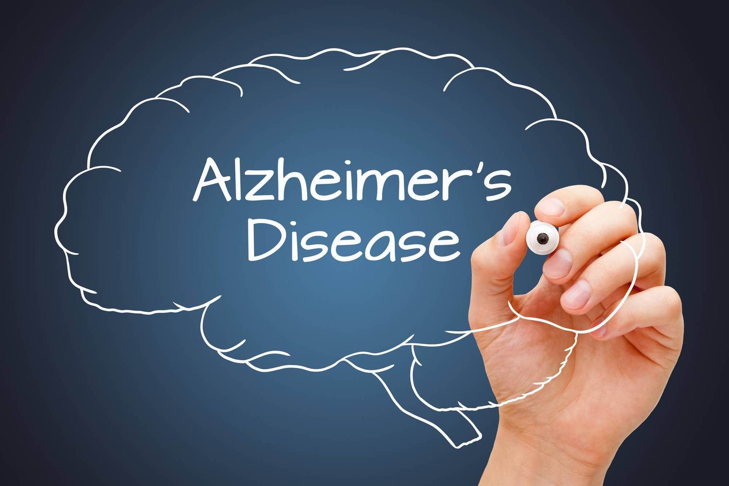 Alzheimer’s Disease 101