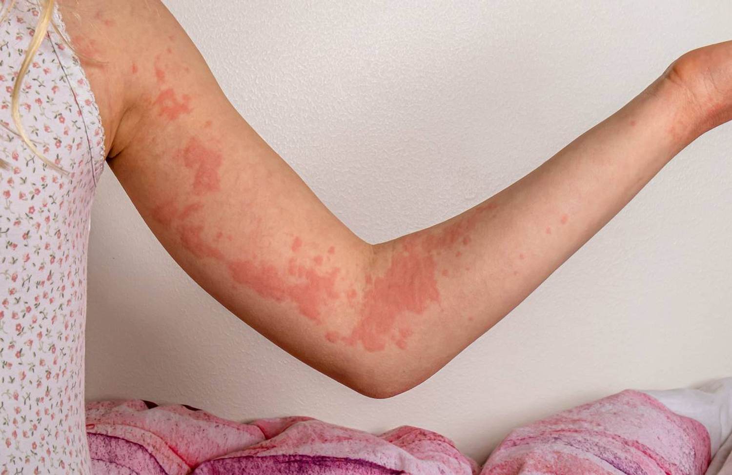 Managing Chronic Hives That Come Out of Nowhere