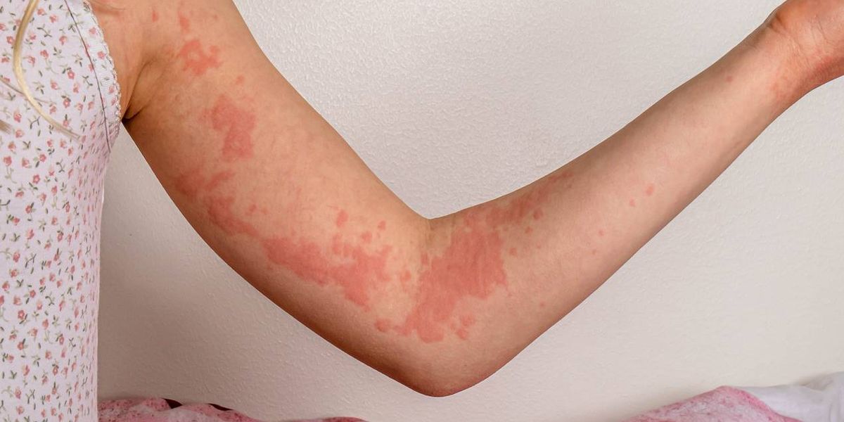 Managing Chronic Hives That Come Out of Nowhere