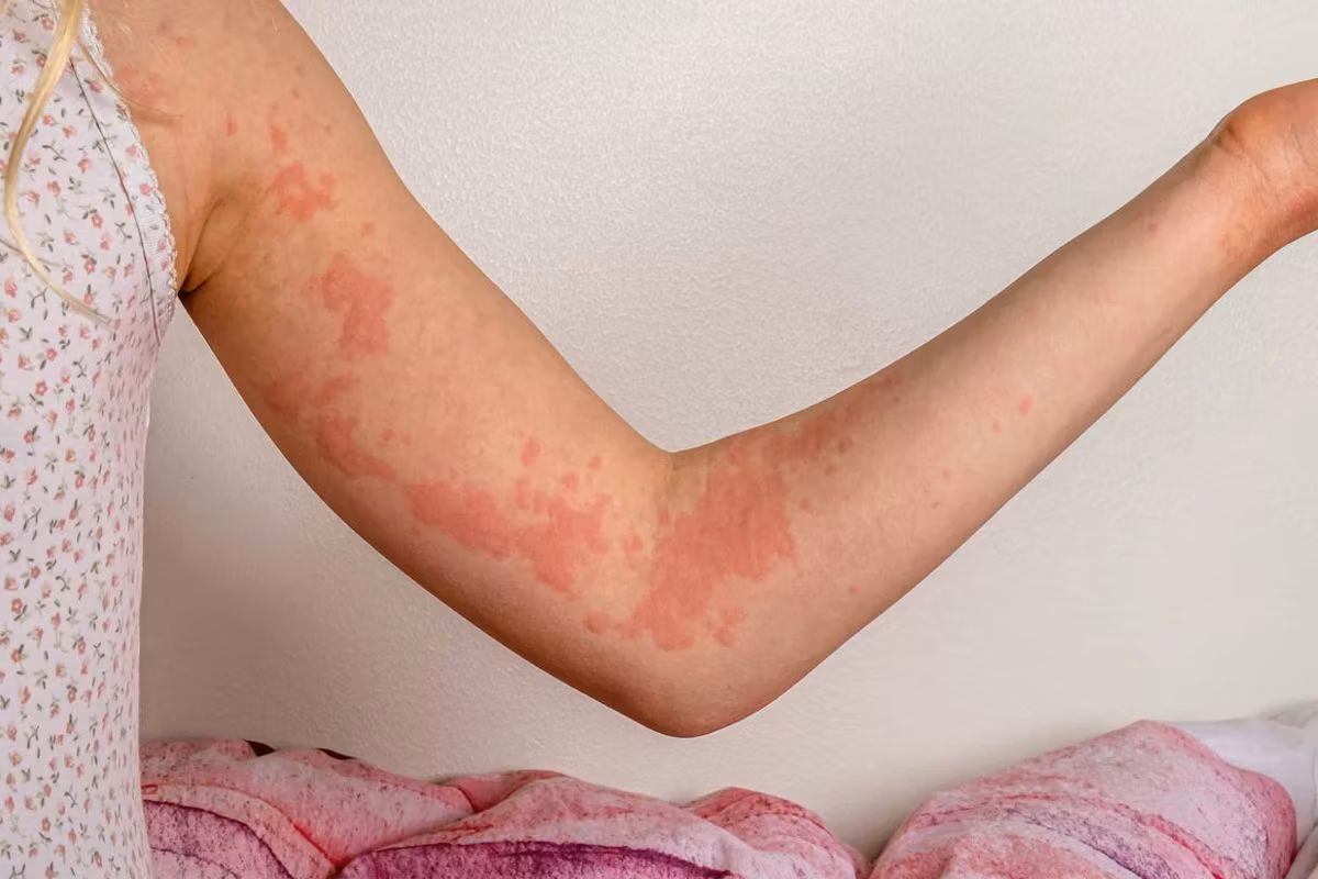 An arm with urticaria/hives