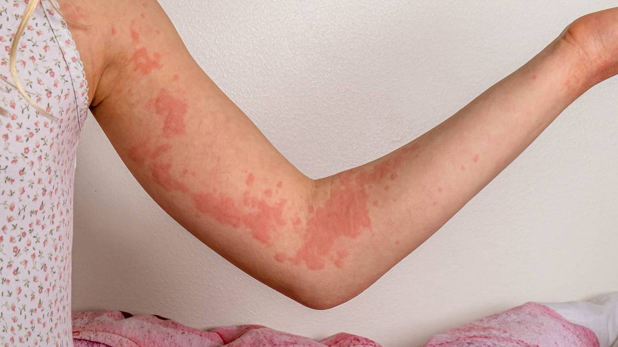 An arm with urticaria/hives