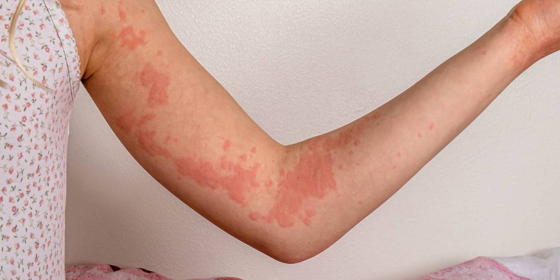 An arm with urticaria/hives