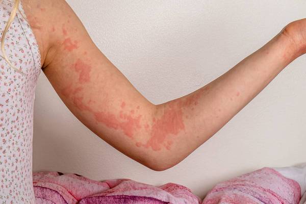 An arm with urticaria/hives