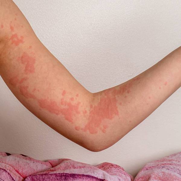 An arm with urticaria/hives