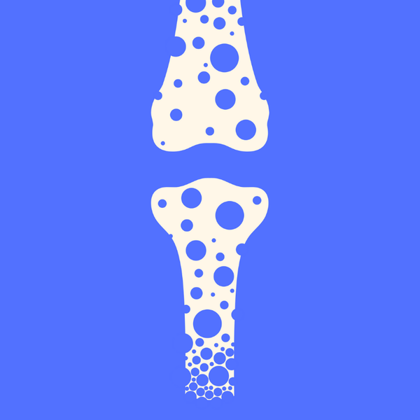 Are You at Risk for Osteoporosis?