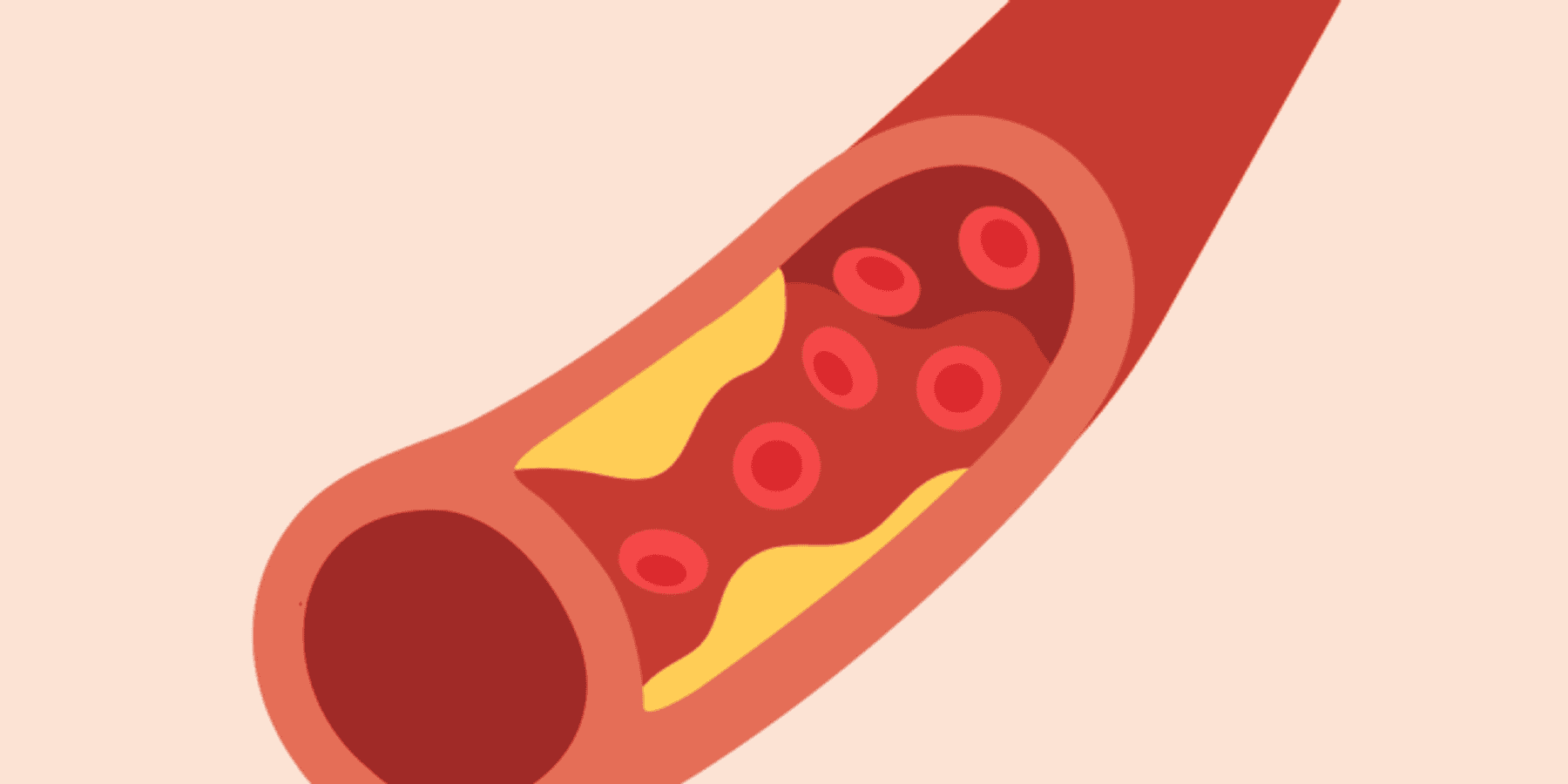 Atherosclerosis and Heart Disease