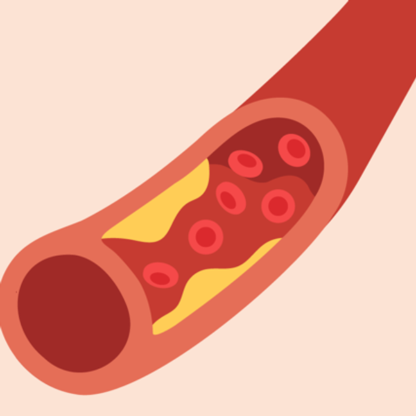 Atherosclerosis and Heart Disease