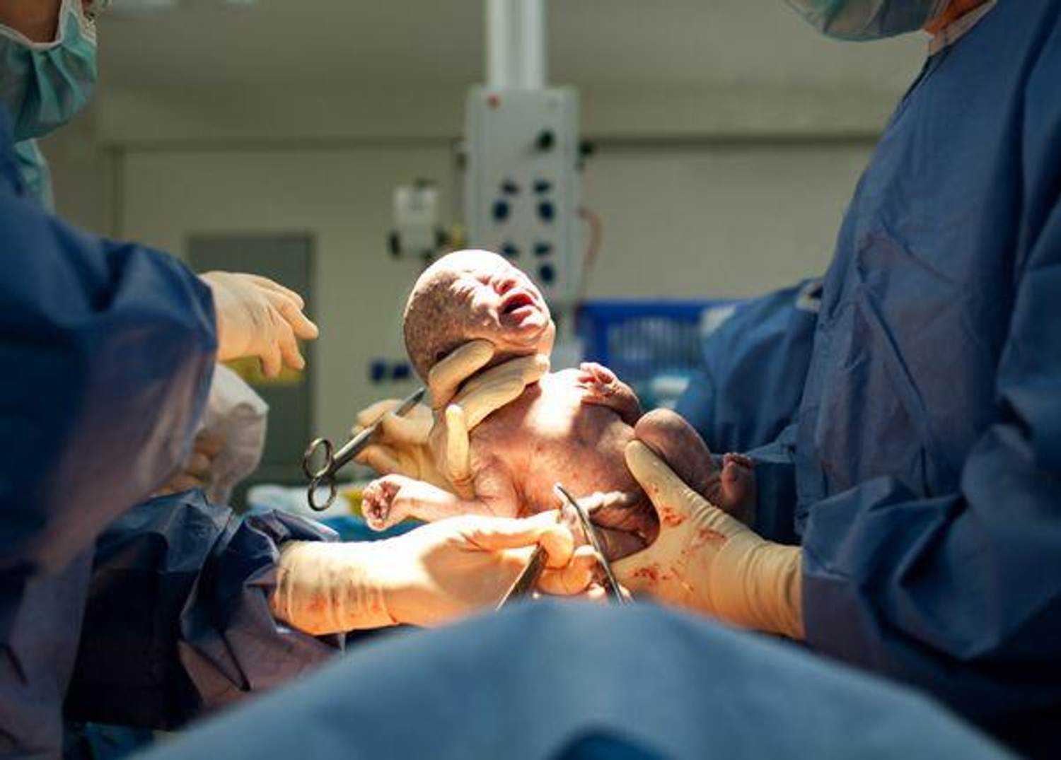 The Gentle Cesarean: More Like a Birth Than an Operation