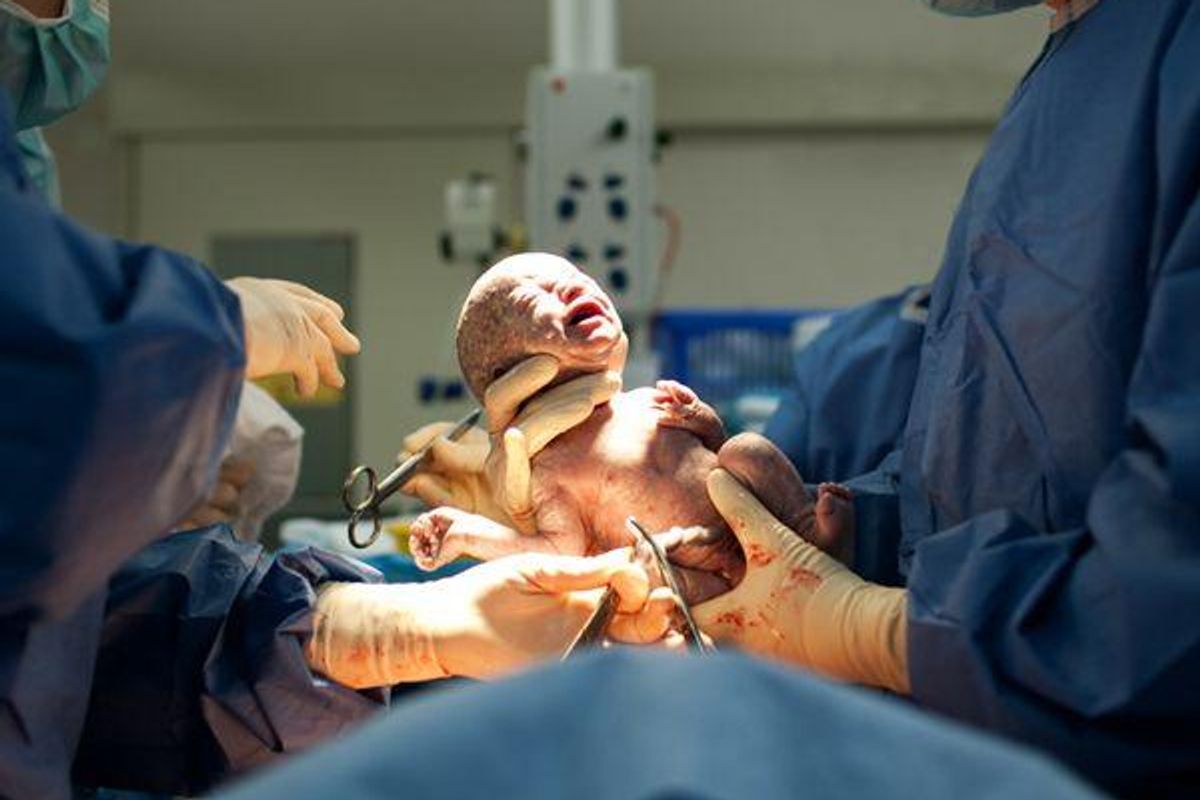 baby being born via c-section