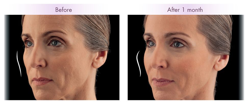 before and after juvederm