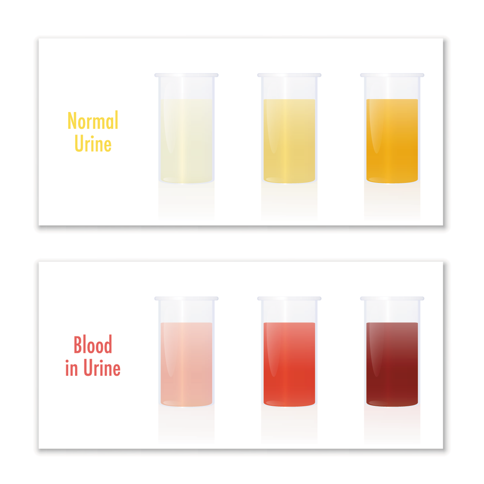 Blood dans l'urine et l'urine normale dans les tasses d'échantillons, à titre de comparaison pour l'examen en laboratoire et le diagnostic médical de diverses maladies urologiques