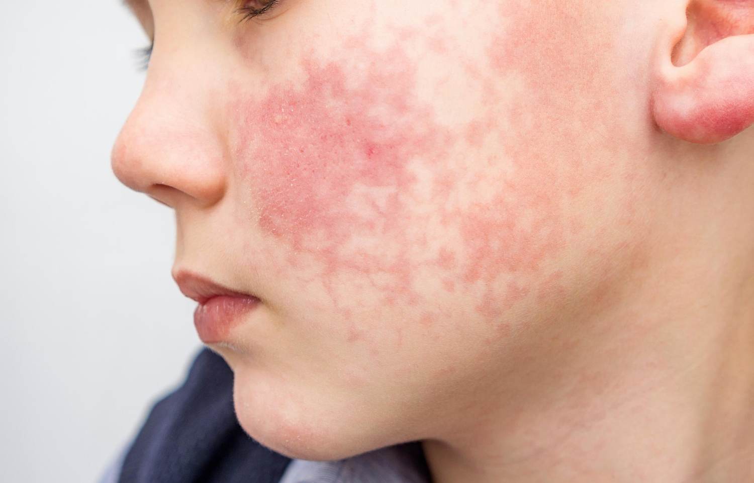 Should Your Child See a Dermatologist?