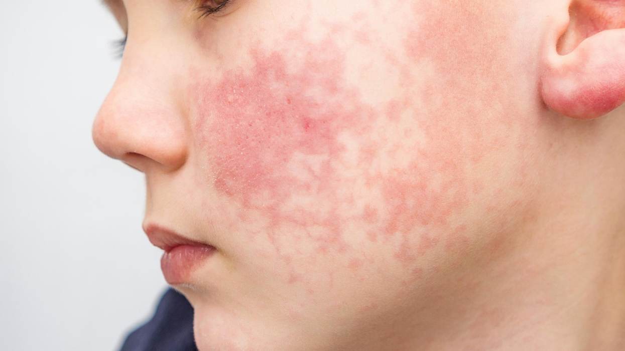 Should Your Child See a Dermatologist?