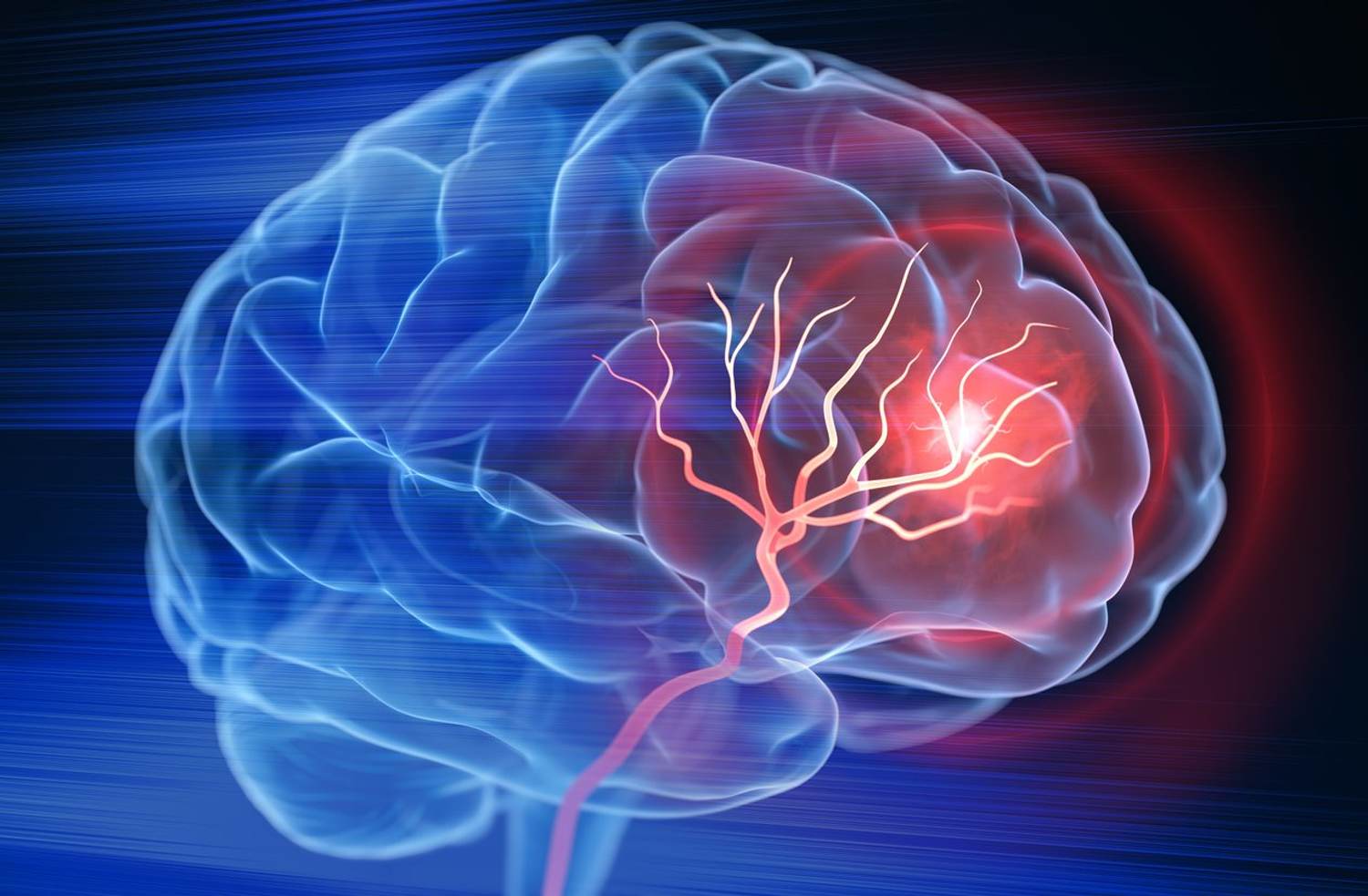 Prevent Permanent Stroke Damage