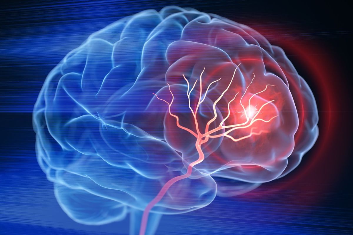 Brain stroke