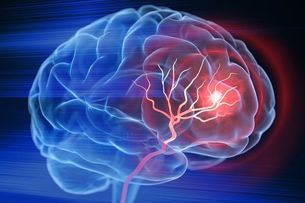 Brain stroke