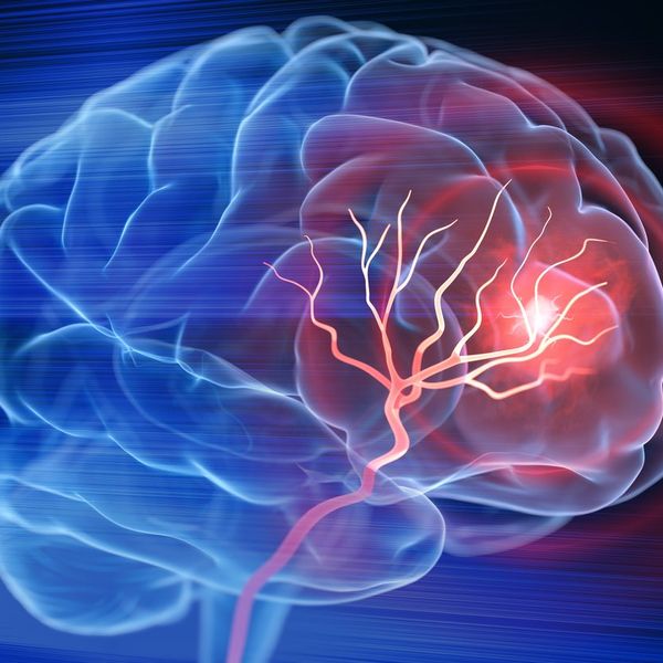 Brain stroke