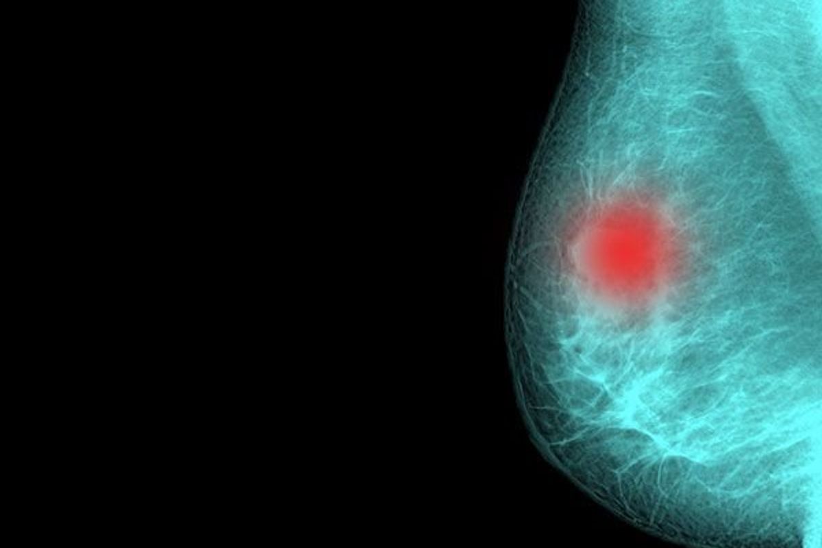 breast cancer imaging