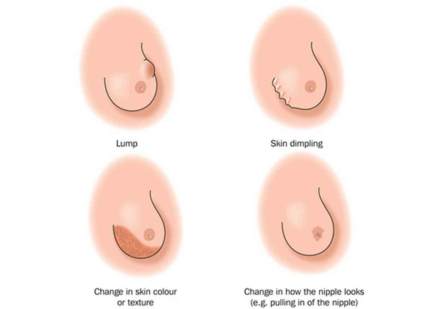 Finding a Lump or Other Change in Your Breasts