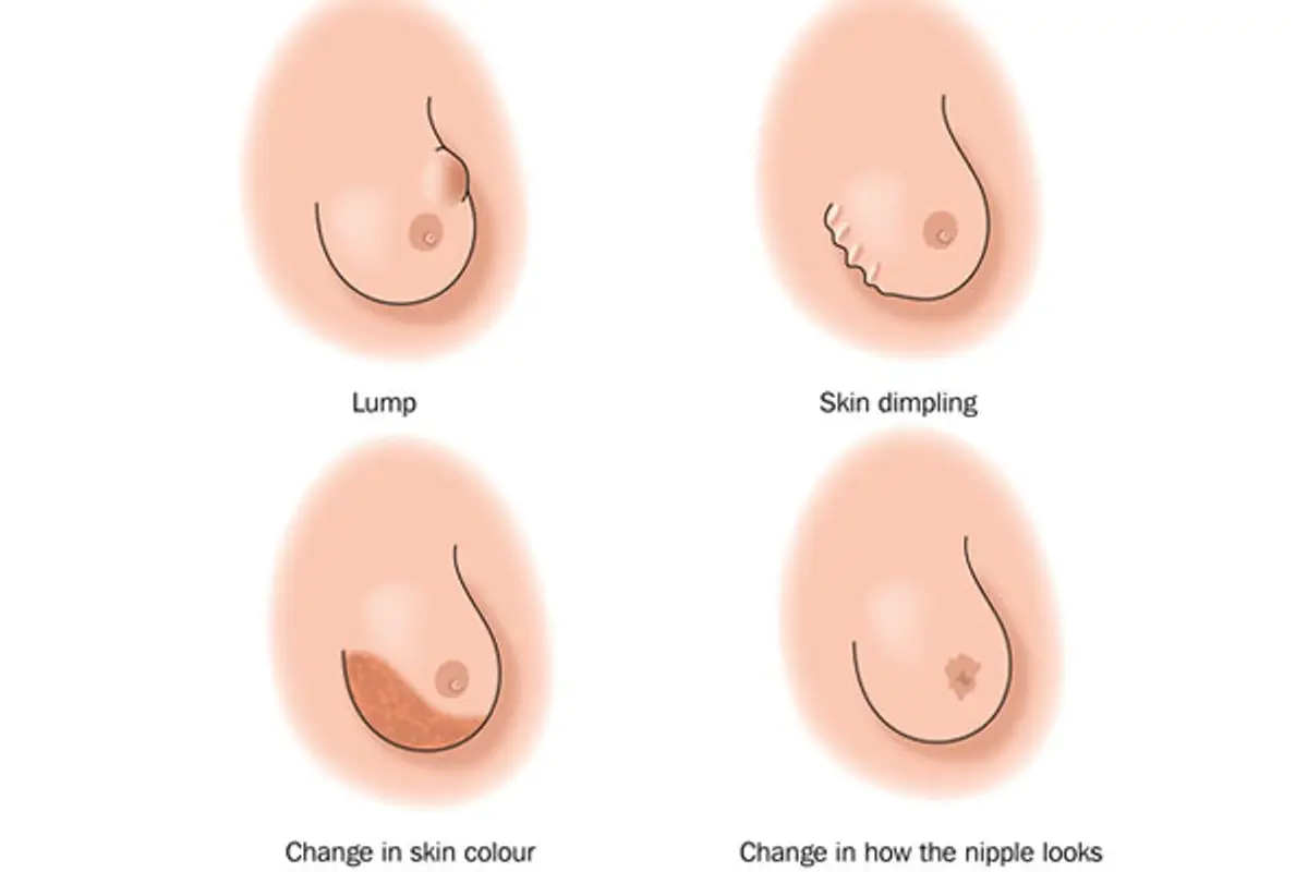 breast changes