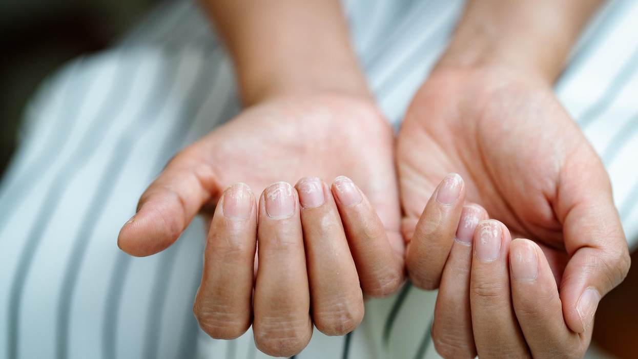 How is Scleroderma Treated?
