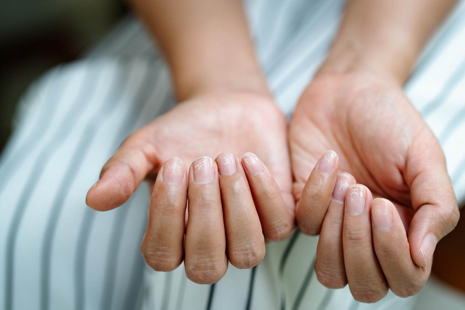 How is Scleroderma Treated?