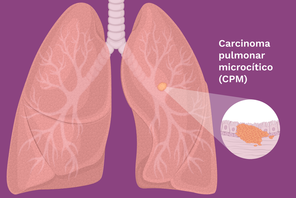 Carcinoma pulmonar microc\u00edtico (CPM)