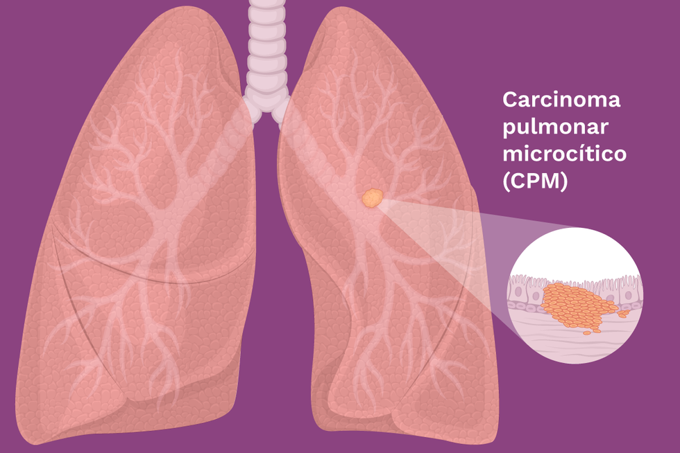 Karsinoma paru kecil (CPM)