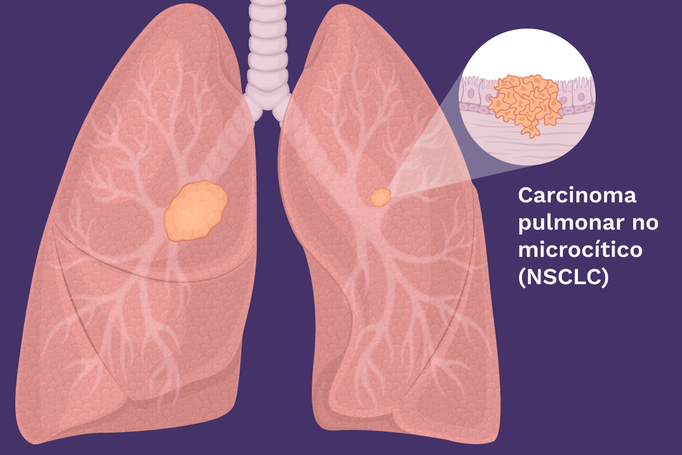 Carcinoma pulmonar no microc\u00edtico (NSCLC)