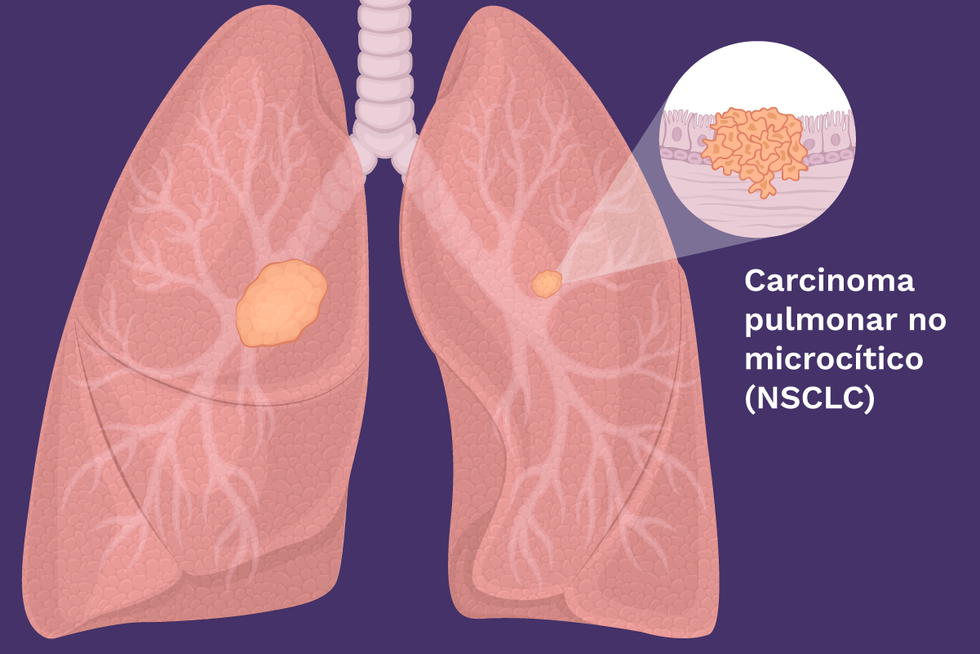 Carcinoma pulmonar no microcu00edtico (NSCLC)