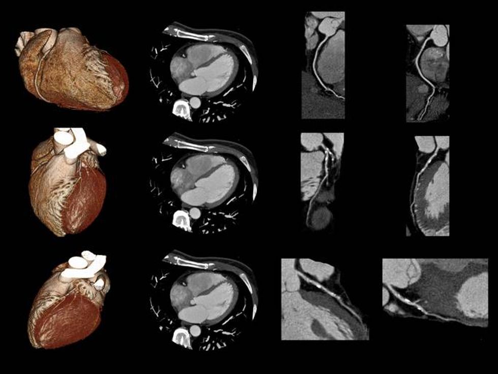 Cardiac CT