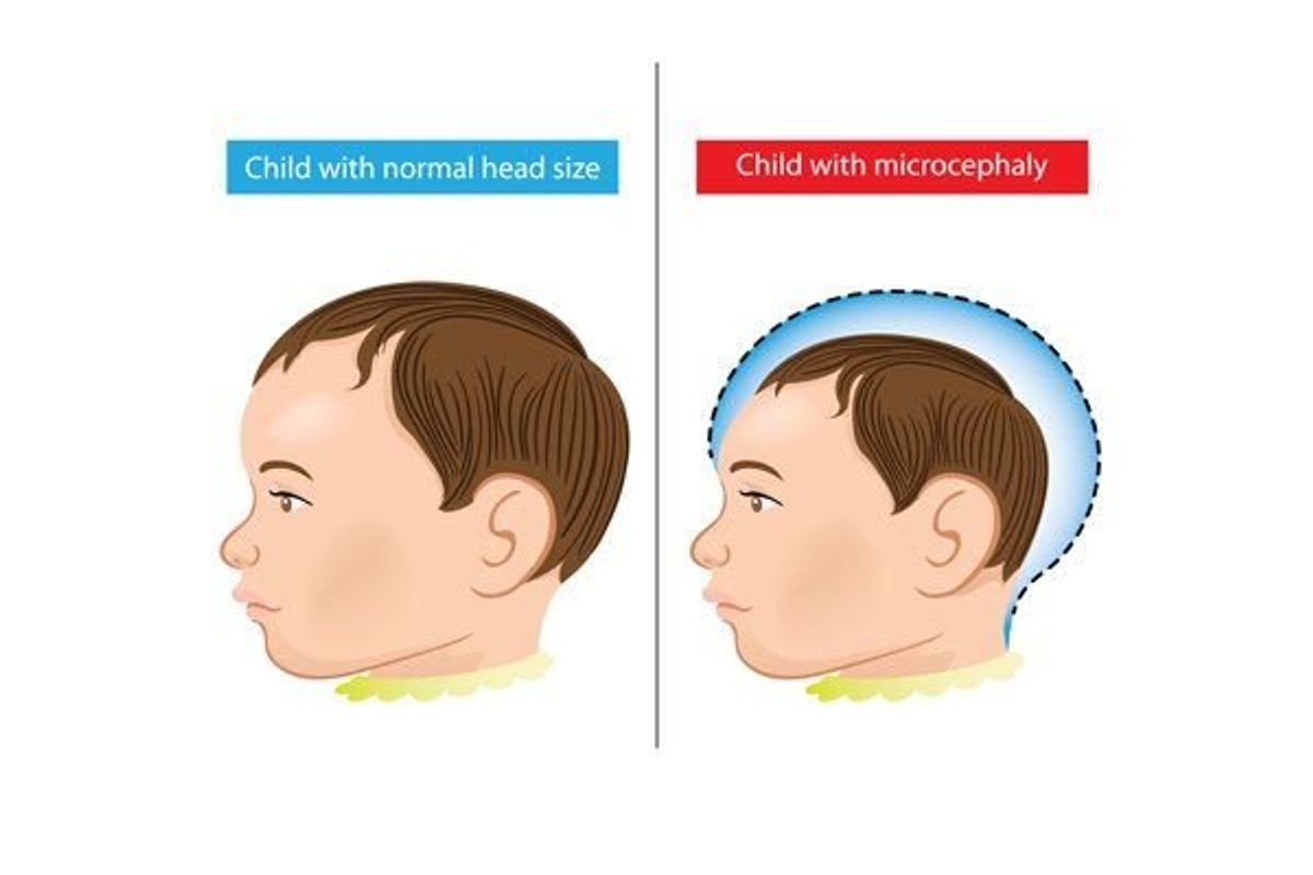 child with microcephaly