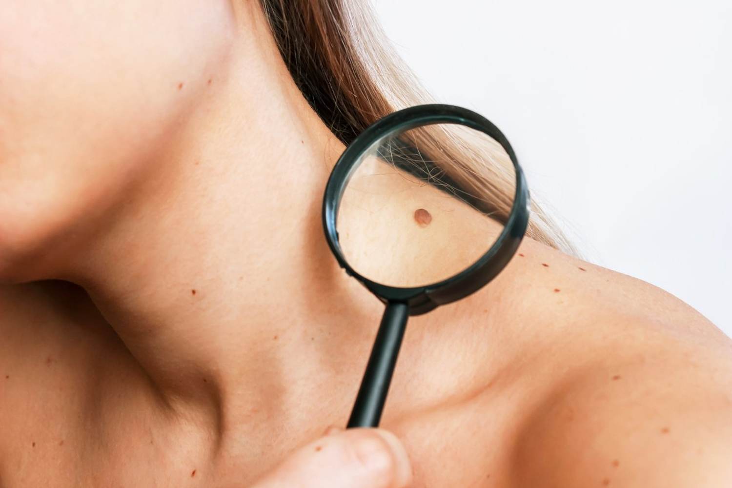Melanoma 101