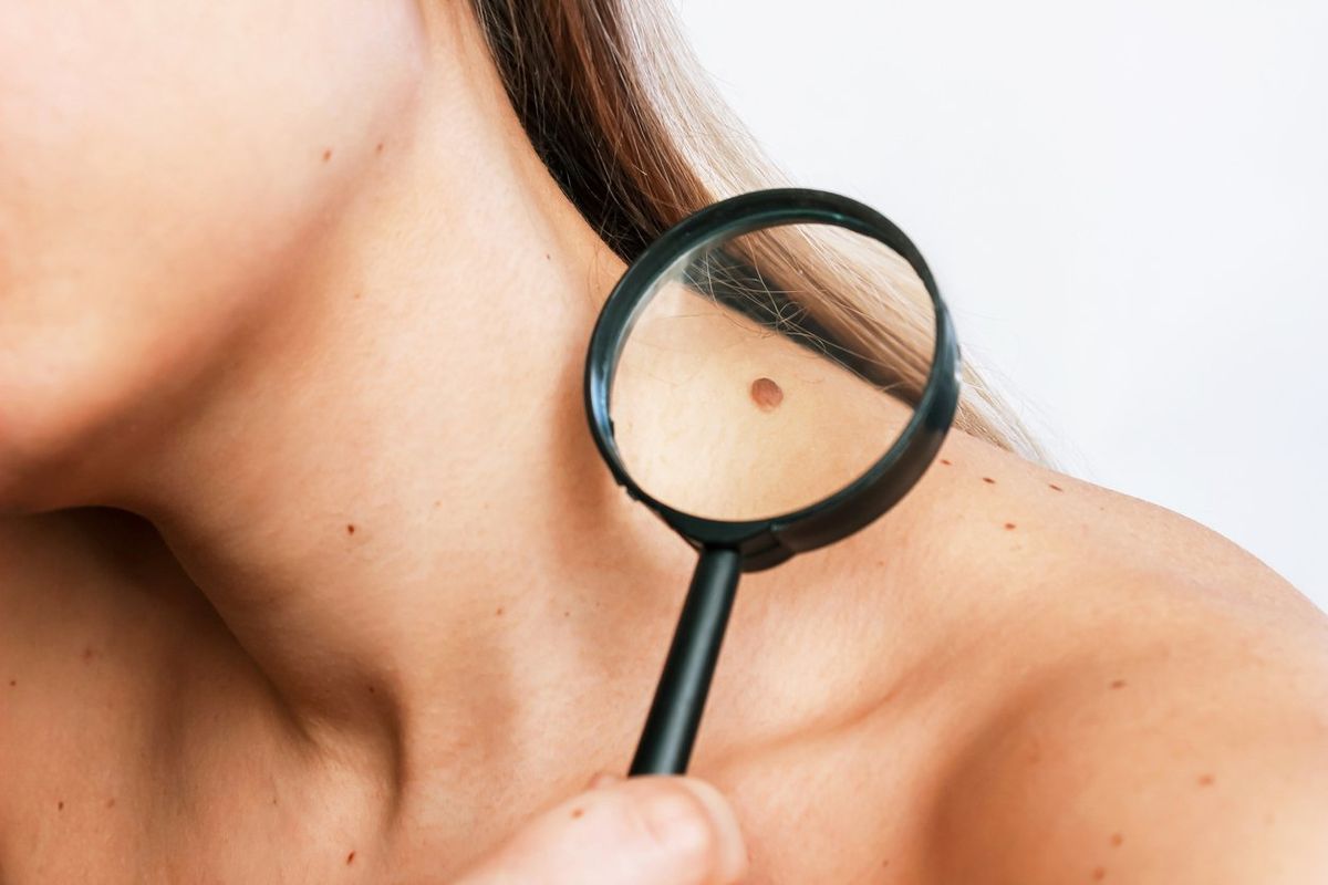 Close-up of a big mole on a young woman's neck magnified with a magnifying glass