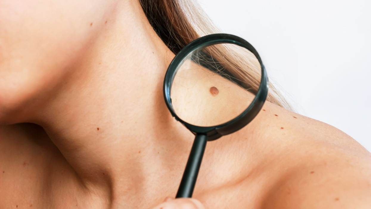 Melanoma 101