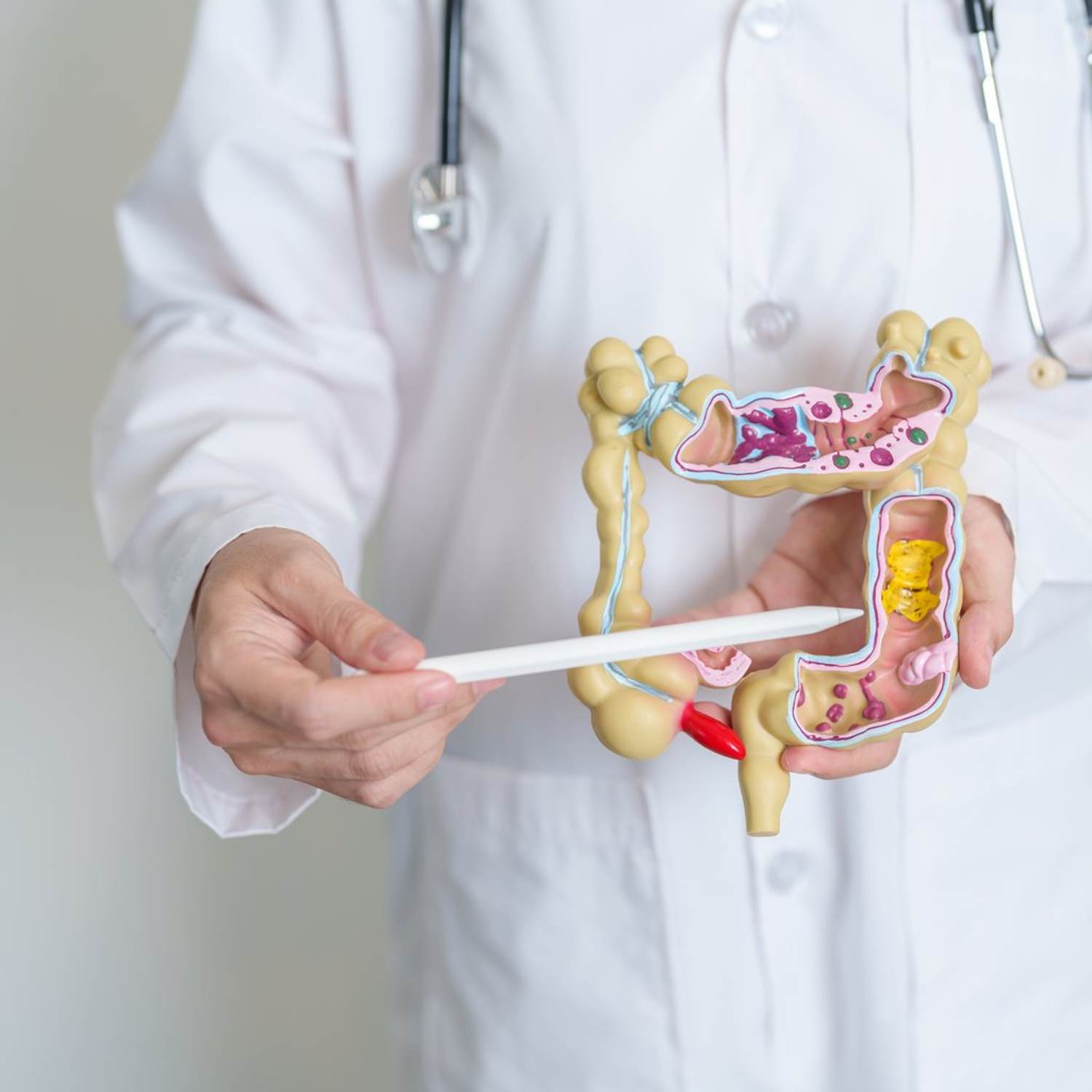 Colorectal Cancer