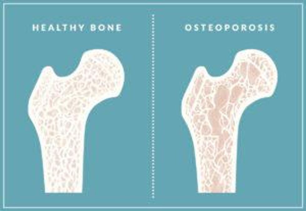 comparison of bone with and without osteoporosis