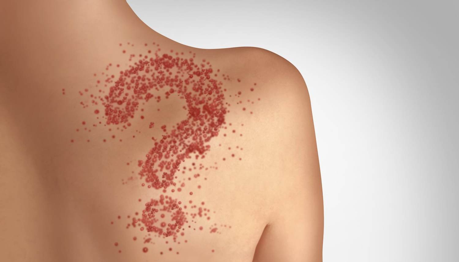 Measles Is Baaaack. Are You At Risk?