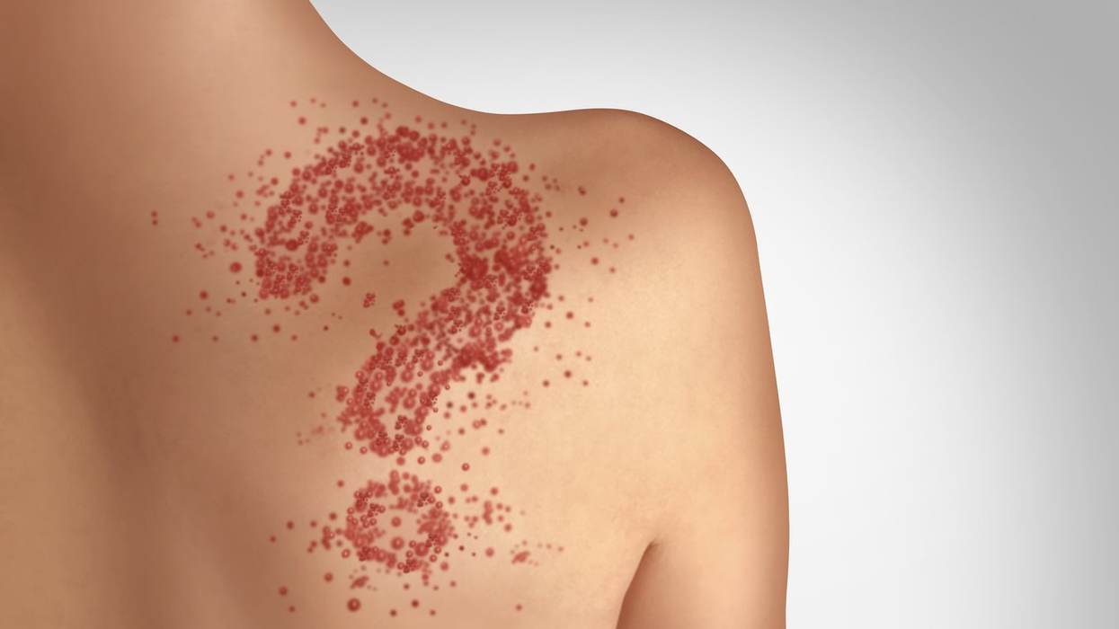 Measles Is Baaaack. Are You At Risk?
