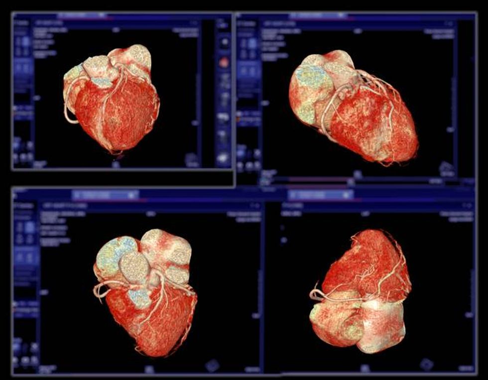 CTA Coronary artery 3D rendering