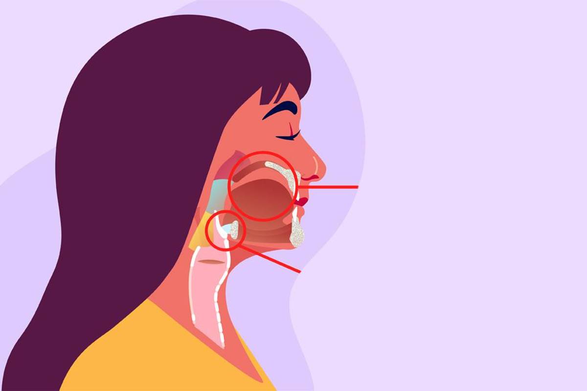 ¿Cuál es la conexión entre el VPH y el cáncer de cabeza y cuello?