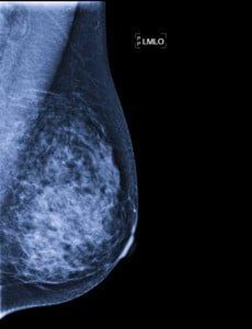 dense breast tissue