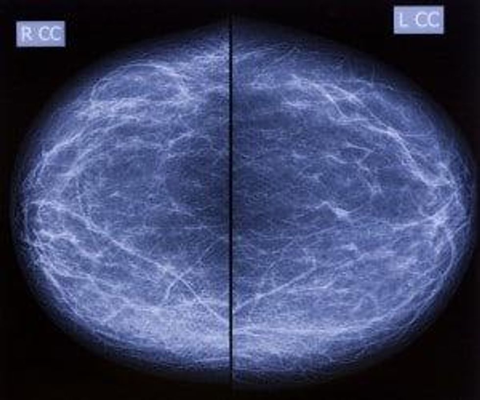 dense breast tissue