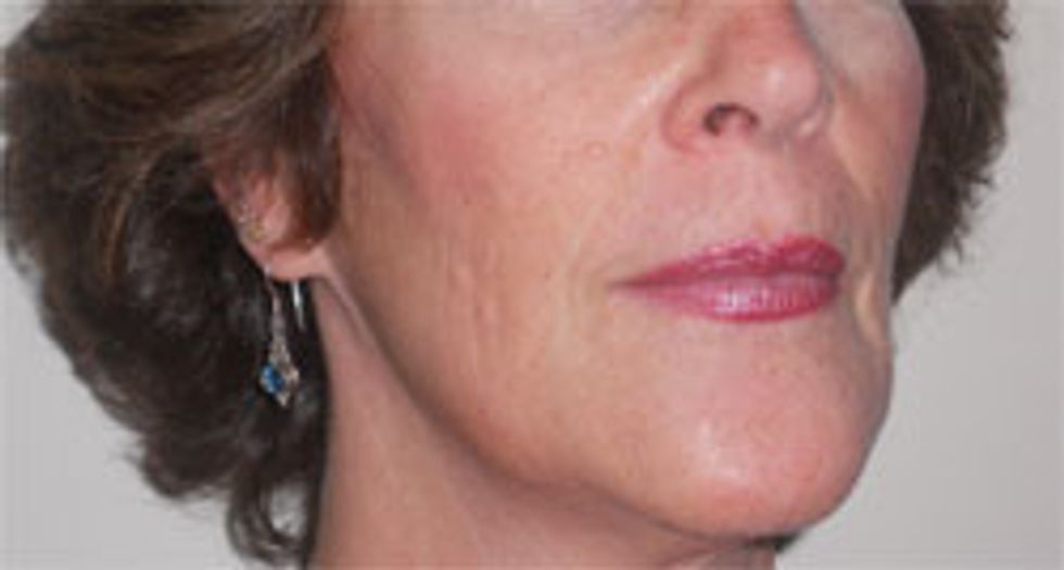 dermal fillers - carolyn after close-up chin